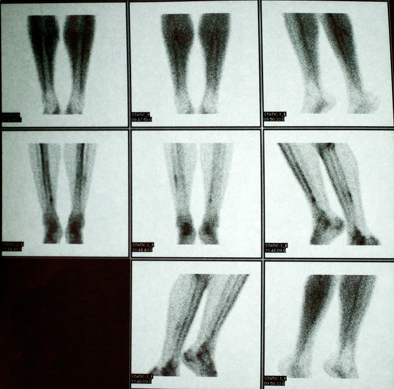 Gammagrafía de la maltrecha pierna.